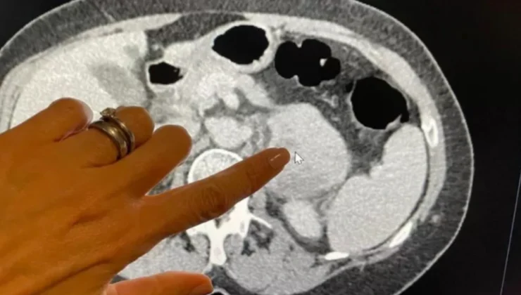 Kanser teşhisinde yapay zeka: İki kat daha başarılı